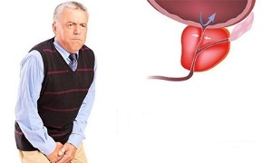 erkeklerde prostatit semptomları