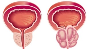 prostatit ve prostat adenomunun gelişmesinin nedenleri
